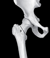 Breuk boven het brede gedeelte van het dijbeen